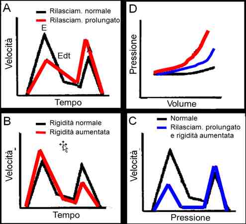 Figura 16a - Esempi di profili di flusso transmitralico normale (A), con rilasciamento prolungato (A), con complianza ridotta (B) e concomitanza di severo prolungamento del rilasaciamento e riduzione della complianza di camera (C). In D: esempi di curve pressione-volume normale (nera), e diversi gradi di riduzione della complianza di camera VS (blu e rossa)