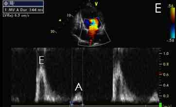 Figura 18c - Esame Doppler pulsato mitralico