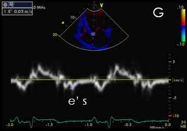 Figura 18f - Esame Doppler tessutale annulus mitralico laterale