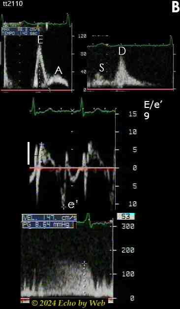 Figura 26B - Cardiomiopatia restrittiva