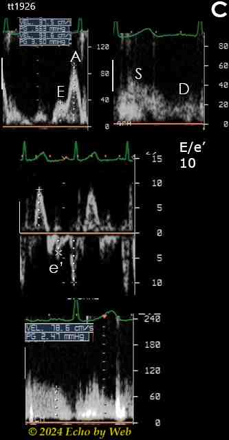 Figura 26C - Ipertensione arteriosa e dispnea