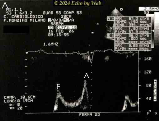 Figura 27A - Doppler pulsato mitralico