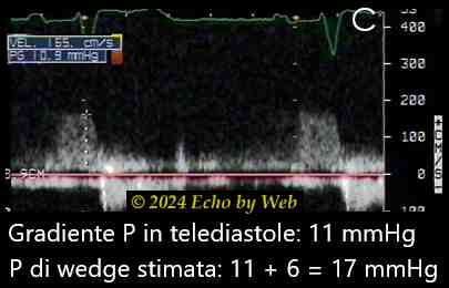 Figura 27 C - Doppler continuo rigurgito polmonare