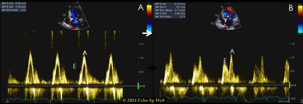 Figura 29 - Doppler pulsato mitralico con tachicardia (A) e dopo massaggio del seno carotideo (B)