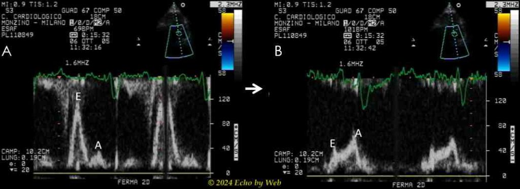 Figura 33 - Doppler mitralico basale (A) e durante Fase II della manovra di Valsalva (B) in presenza di fisiologia basale restrittiva ed elevate pressioni di riempimento