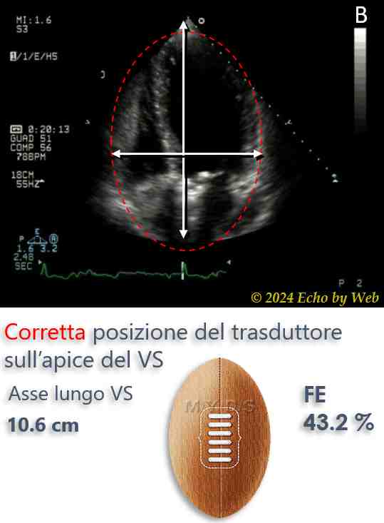 Figura 08b - Corretta geometria VS e dell'aia cardiaca