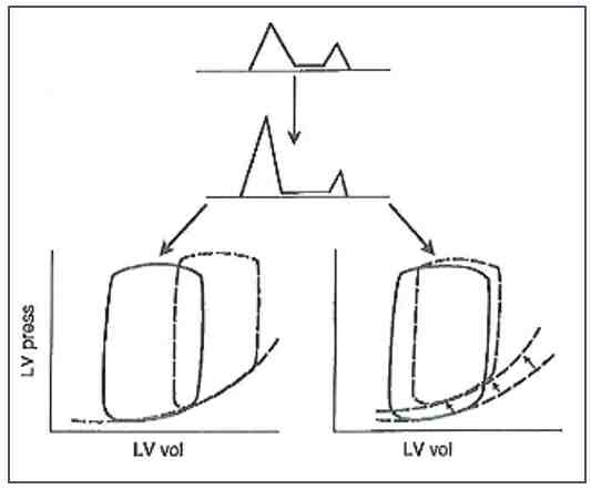 Figura 10b - Profilo "restrittivo" del flusso transmitralico secondario ad incremento della pressione telediastolica per spostamento lungi la stessa curva pressione-volume (a sinistra) o per spostamento in alto ed a sinistra della curba pressione-volume stessa