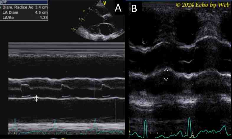 Figura 19 - M-mode della radice aortica, parasternale asse lungo. A: cardiomiopatia dilattaiva; B: soggetto normale