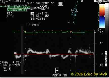 Figura 29e - Doppler tessutale, cardiomiopatia dilatativa, al ricovero