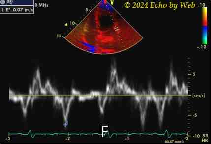 Figura 29f - Doppler tessutale, cardiomiopatia dilatativa, follow-up 2 anni