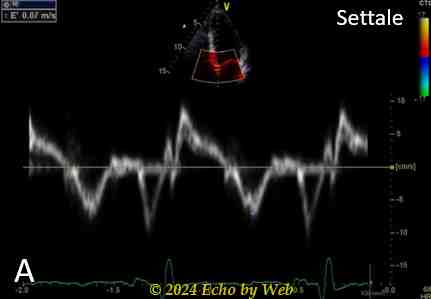 Figura 31a . Doppler tessutale settale, cardiopatia ischemica con alterazioni della cinesi parietale medio-apicali