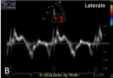 Figura 31b Doppler tessutale laterale, cardiopatia ischemica con alterazioni della cinesi parietale medio-apicali