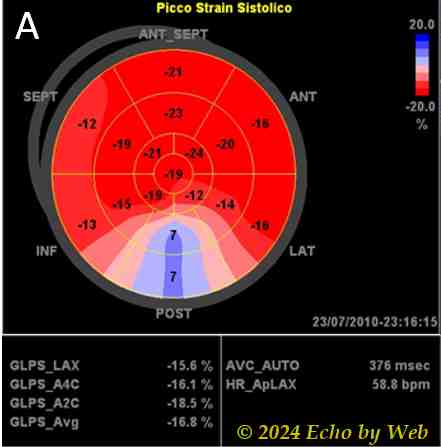 Figura 42a - Bull's eye della deformazione parietale (strain) longitudinale sistolica in un paziente con pregresso infarto miocardico posteriore