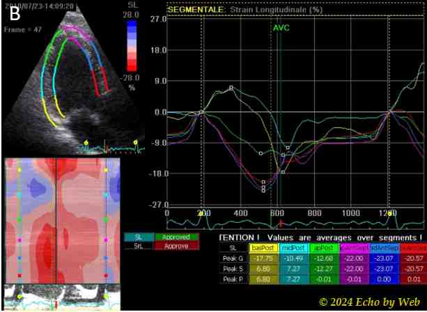 Figura 42b -Curve segmentarie di deformazione parietale (strain) longitudinale sistolica in un paziente con pregresso infarto miocardico posteriore
