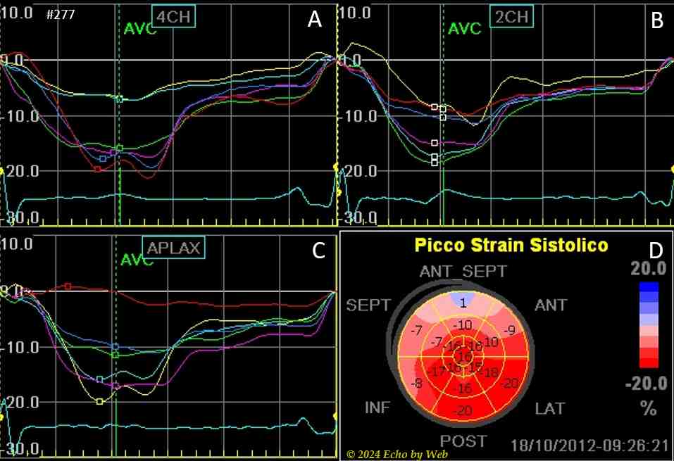 Figura 49 - Cardiomiopatia ipertrofica non ostruttiva (#277)