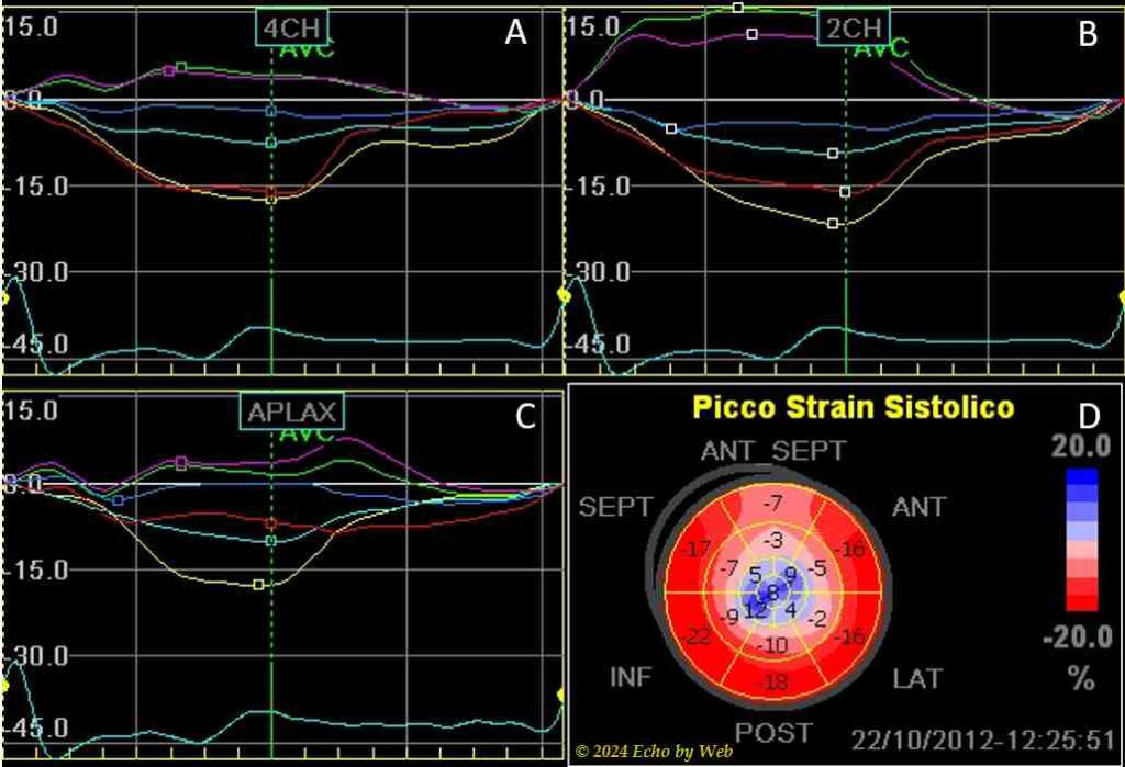 Figura 51 - Strain longitudinale segmentario, cardiomiopatia ipertrofica medio-apicale