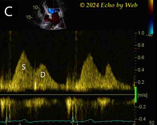 Image 23b - Doppler vena polmonare superiore di destra, proiezione apicale 4-camere