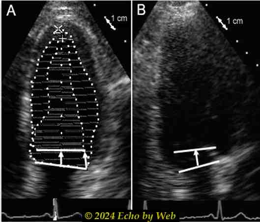 Image 25ab - La discesa sistolica dell'annulus mitralico, proiezioni apicali 4- (A) e 2-camere (B)
