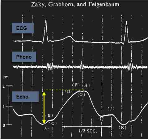 Image 25c - Zaky, Grabhorn and Feigenbaum. Movement of the mitral ring. A study in ultrasonography. Cardiovasc Res 1967