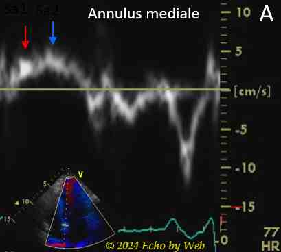 Image 28a - tenosi aortica, Doppler tessutale annulus medial