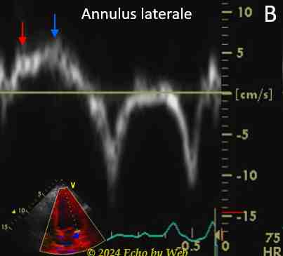 Image 28b - Stenosi aortica, Doppler tessutale annulus laterale