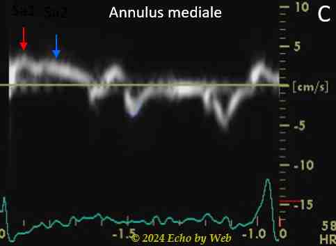 Image 28c - Cardiomiopatia dilatativa, Doppler tessutale annulus mediale