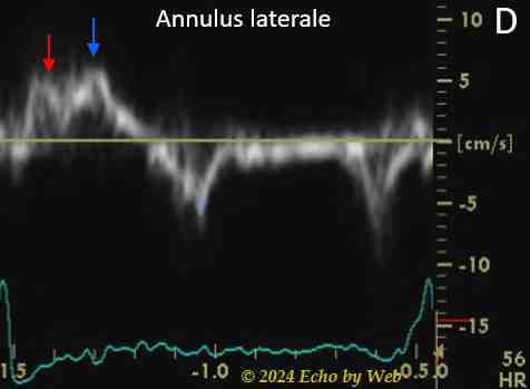 Image 28d - Cardiomiopatia dilatativa, Doppler tessutale annulus laterale