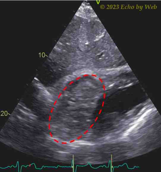 Figure 8 – Subcostal 4-chamber view