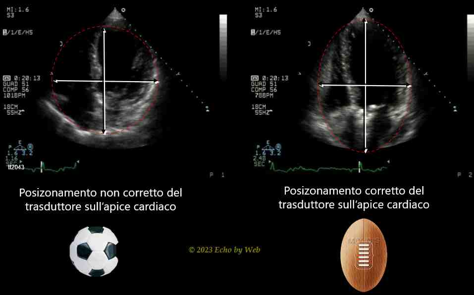 Figura 11 - Aia cardiaca SCORRETTA a tipo di "pallone da calcio" ed aia cardiaca CORRETTA a tipo di "pallone da rugby"