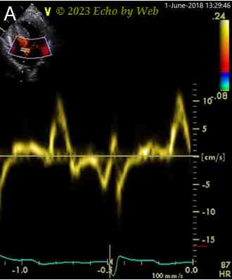Figura 31a
Figura 31A - Doppler pulsato tessutale annulus mitralico mediale, proiezione apicale 4 camere
