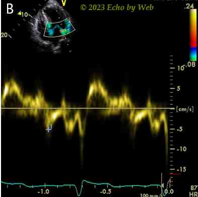 Figura 31B - Doppler pulsato tessutale annulus mitralico laterale, proiezione apicale 4 camere