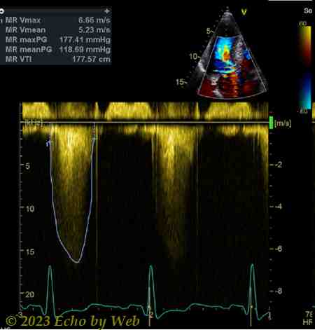 Figura 41 - Doppler continuo rigurgito mitralico, proiezione apicale 5-camere