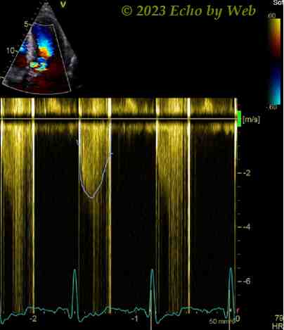 Figura 42 - Doppler continuo protesi meccanica valvolare aortica, proiezione apicale 5-camere