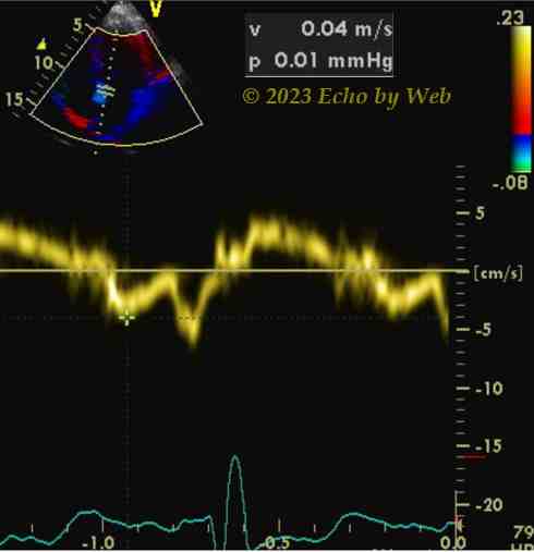 Figura 48A - Doppler pulsato tessutale, annulus mitralico mediale