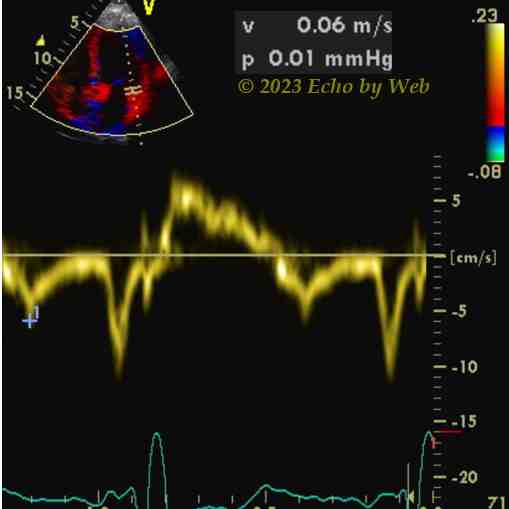 Figura 48B - Doppler pulsato tessutale, annulus mitralico laterale