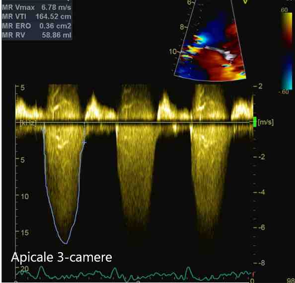 Figura 54 - Doppler continuo rigurgito mitralico, proiezione apicale 4-camere