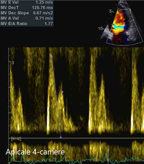 Figura 55 - Doppler pulsato transmitralico