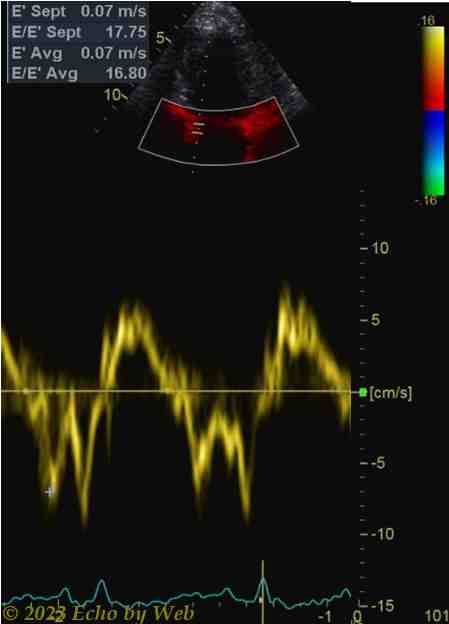 Figura 57A - Doppler pulsato tessutale annulus mitralico mediale