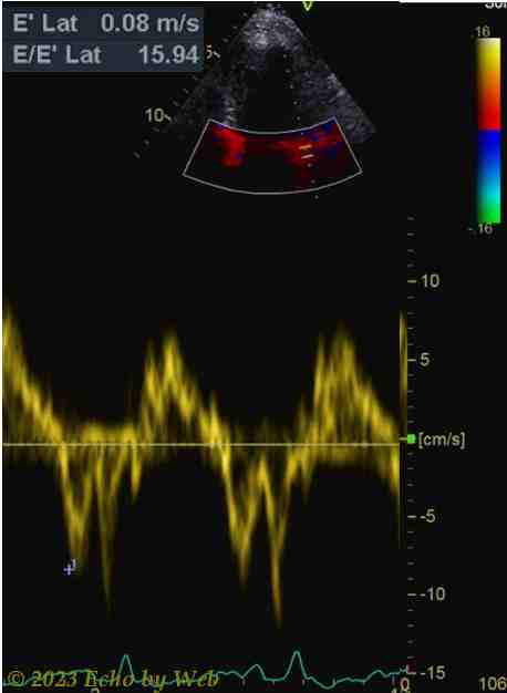 Figura 57B - Doppler pulsato tessutale annulus mitralico laterale