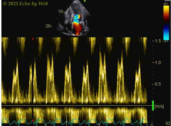 Figura 67 - Doppler pulsato transmitralico, proeizione apicale 4-camere