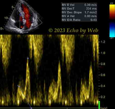 Figura 81 - Doppler pulsato transmitralico